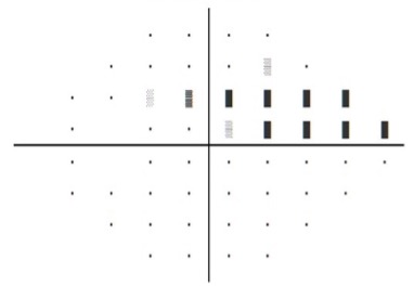 Figure 2. The visual field of a patient with early glaucoma. The large rectangles represent portions of the visual field with reduced sensitivity (impaired sight). This person has lost sight in the upper, inner corner of their vision. Such loss is often asymptomatic and requires detection on visual field testing.
